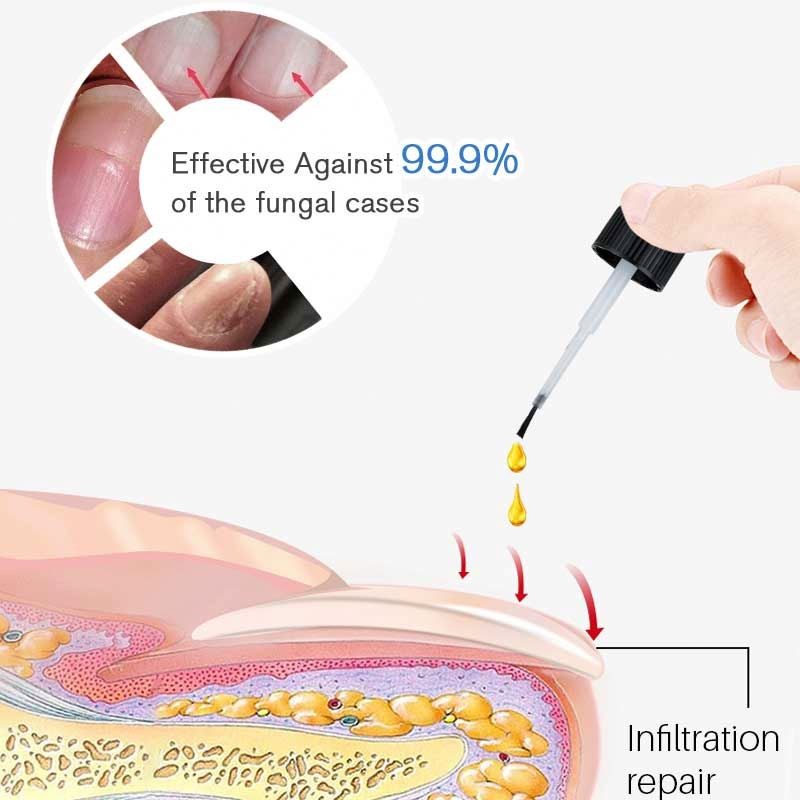 Antifungal Lotion Supplier - Lanthome Nail Fungus Removal Treatment