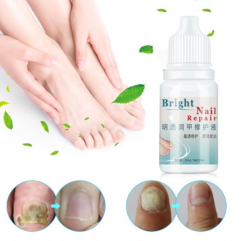 Nail Treatment Supplier - 10ml Anti Infection Nail Care Treatment