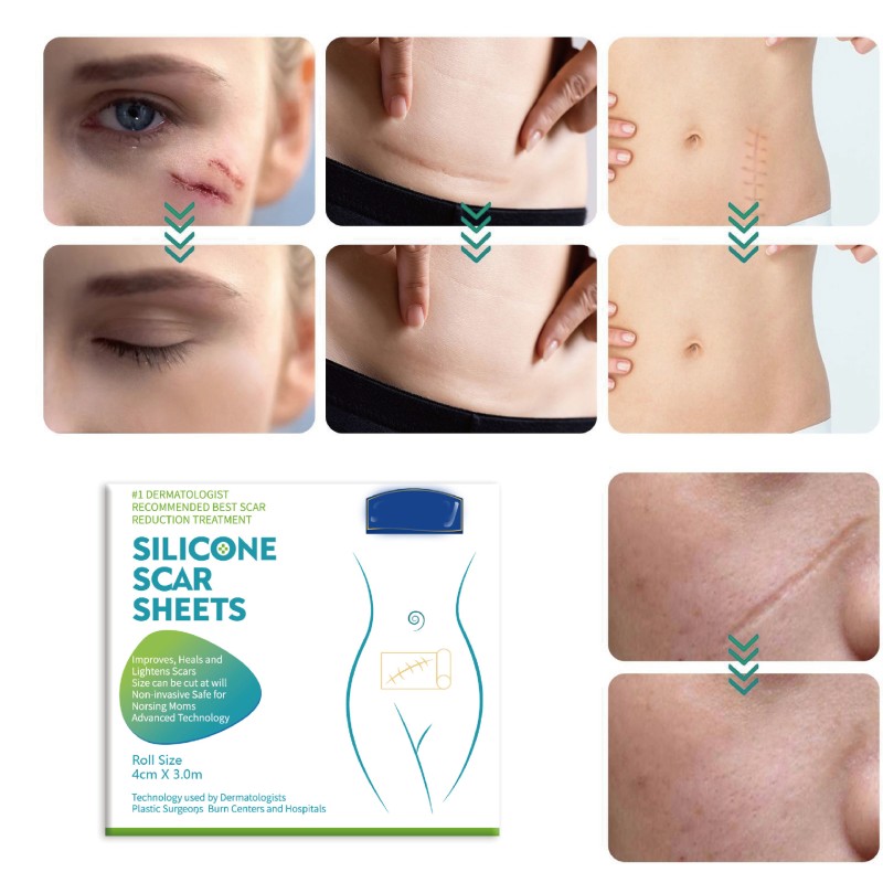 Silicone Scar Gel Supplier - Roll Shape Surgical Scars Removal