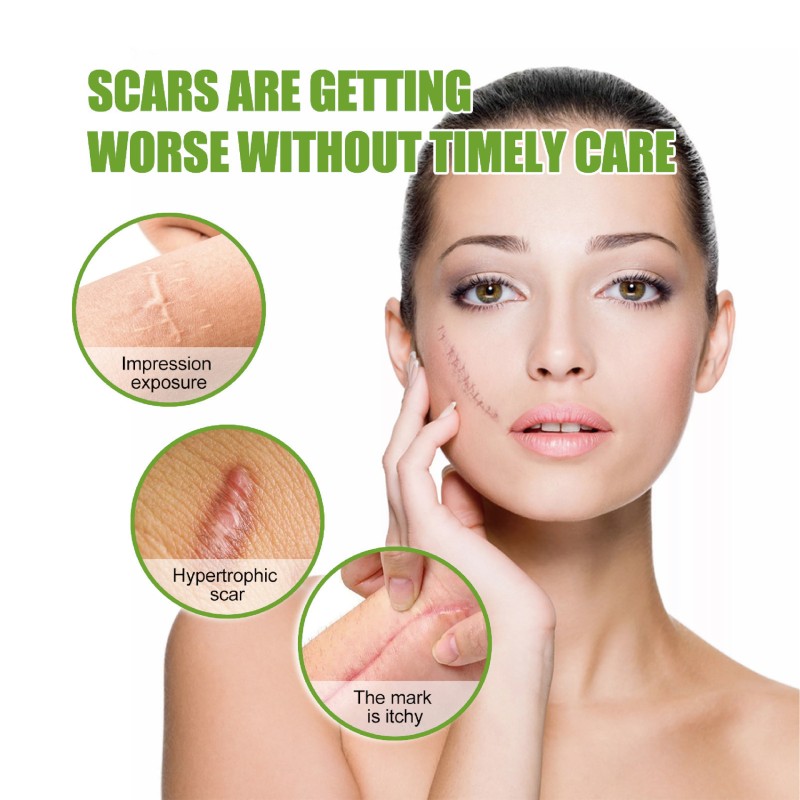 Silicone Scar Gel Supplier - Roll Shape Surgical Scars Removal