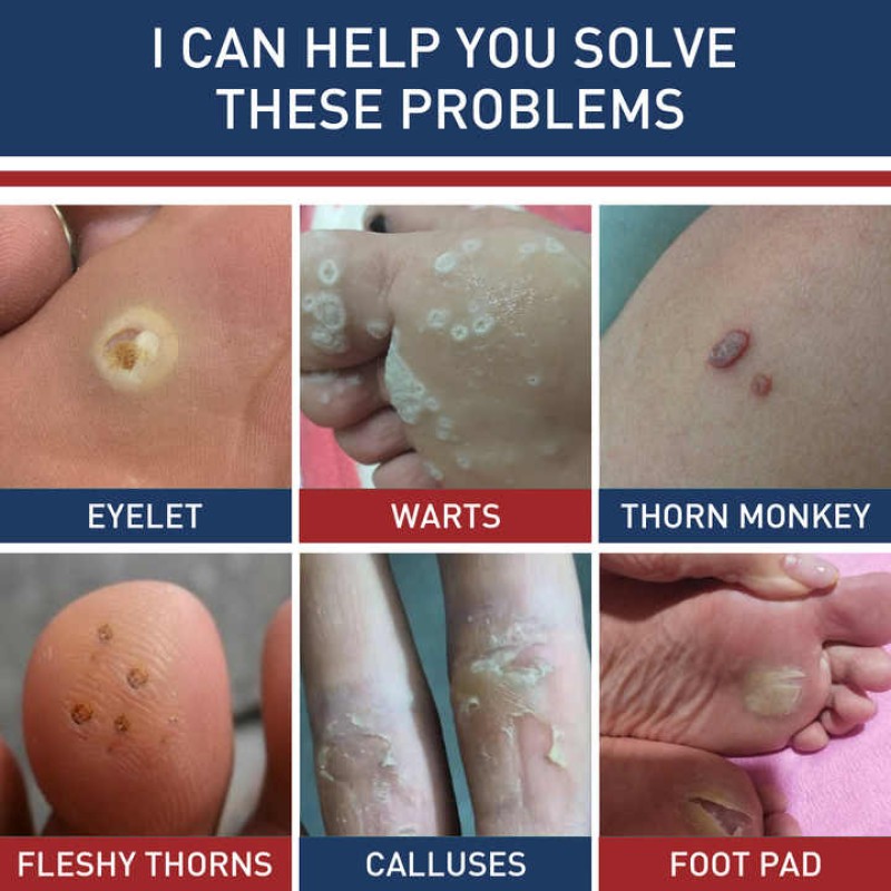 Corn Plaster Supplier - Non-Woven Fabric Herbal Material