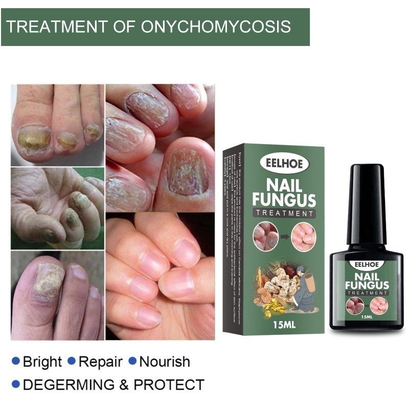 Nail Treatment Supplier - High Quality 15ml Nail Fungus Treatment Nail Health Care