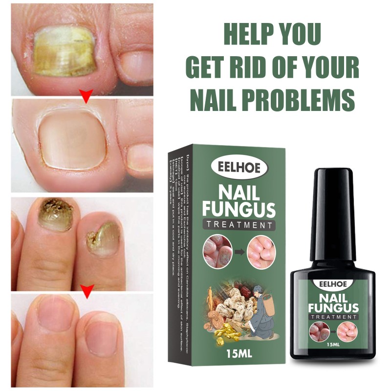Nail Treatment Supplier - High Quality 15ml Nail Fungus Treatment Nail Health Care