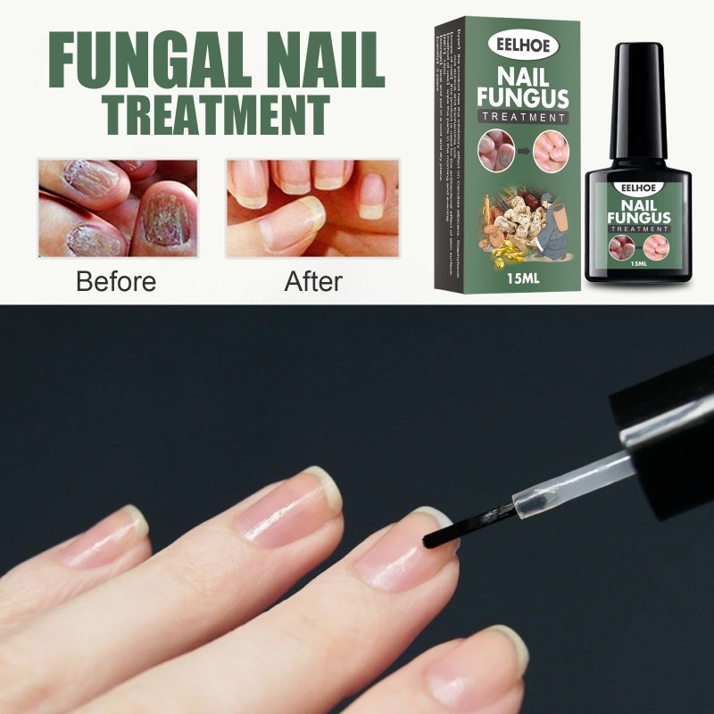 Nail Treatment Supplier - High Quality 15ml Nail Fungus Treatment Nail Health Care