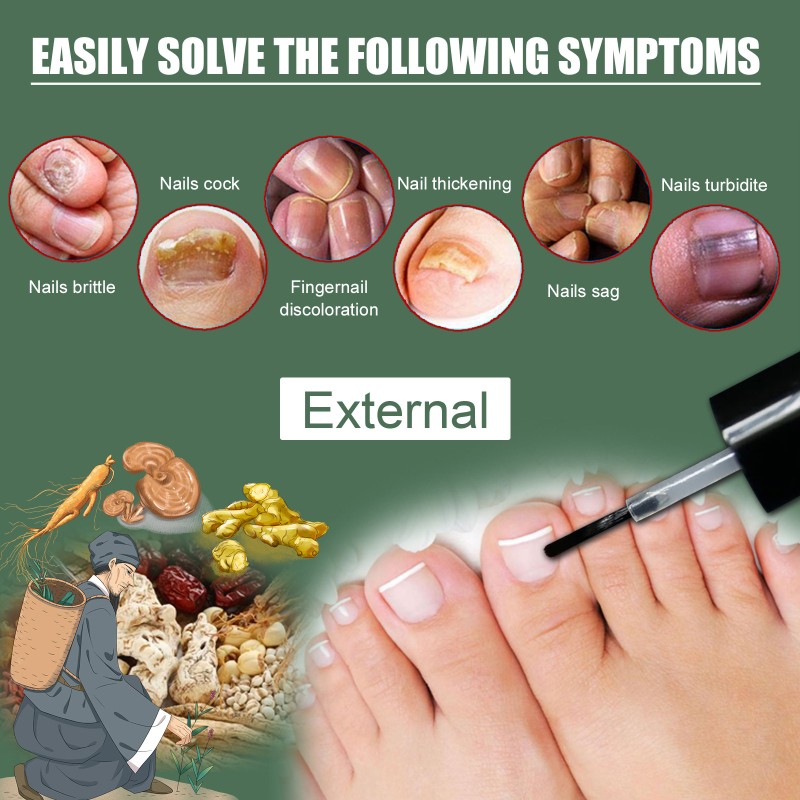 Nail Treatment Supplier - High Quality 15ml Nail Fungus Treatment Nail Health Care