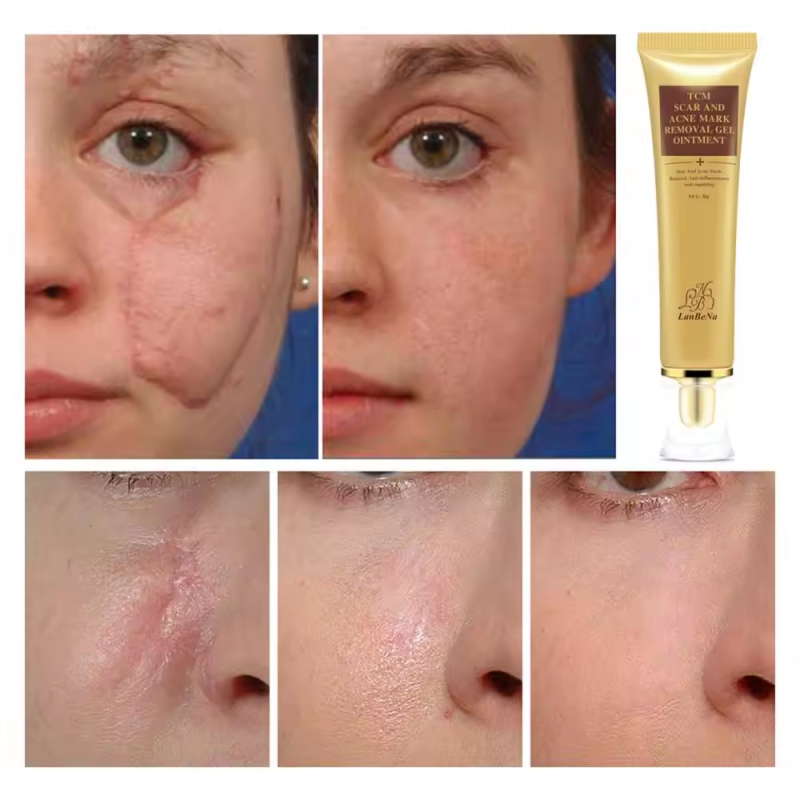 Scar Removal Cream Supplier - Scar Remove Gels Professional Effective Cream Relief Acne Mark