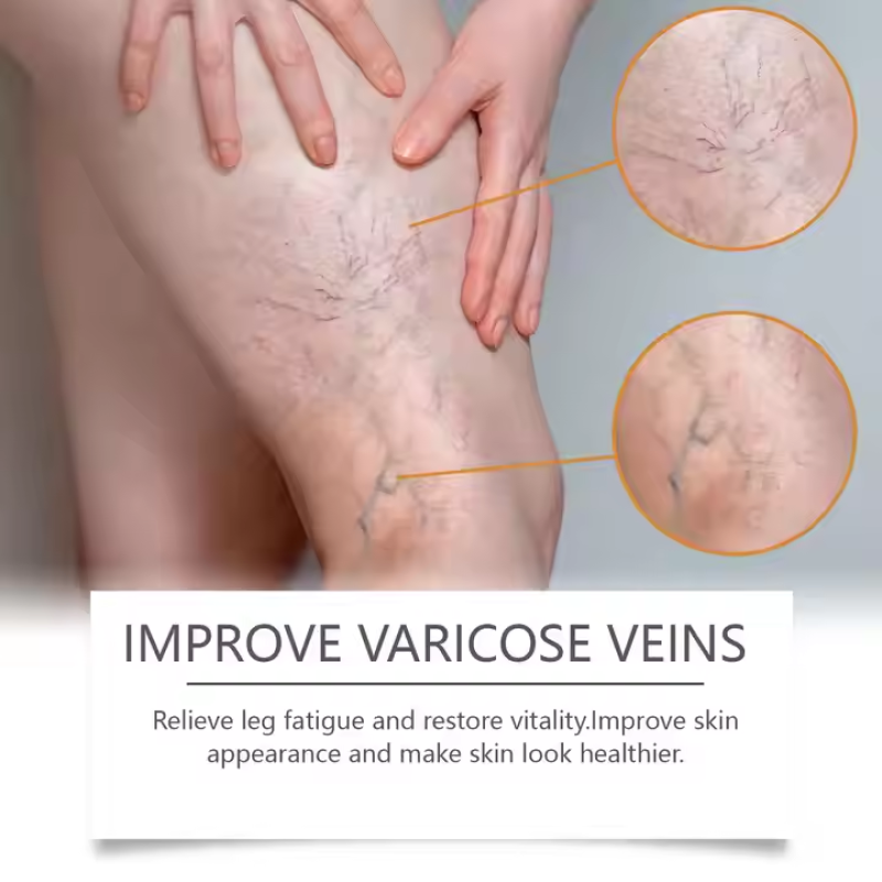 Varicose Veins Gel Factory - Ximonth Horse Chestnut Gel for Varicose Veins Relief Natual