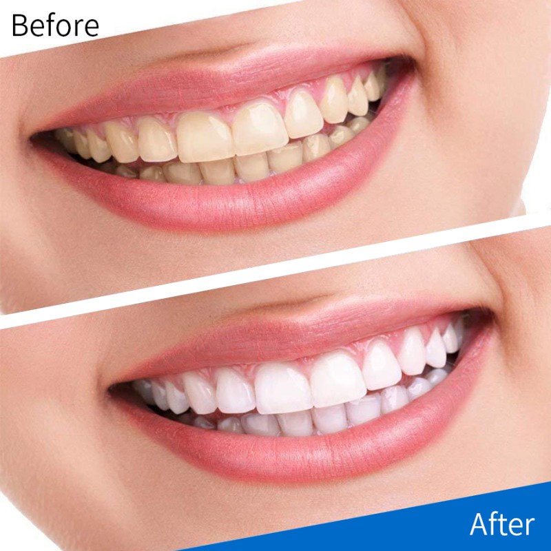 Teeth Whitening Strips Factory - Hot Sell Teeth Whitening Strips 14pairs/Box High Quality