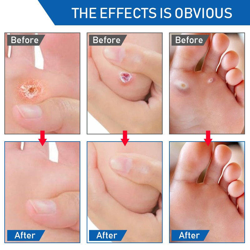 Corn Treatment Pad Manufacturer - Remove Surplus Salicylic Acid Lessen Friction Corn Treatment