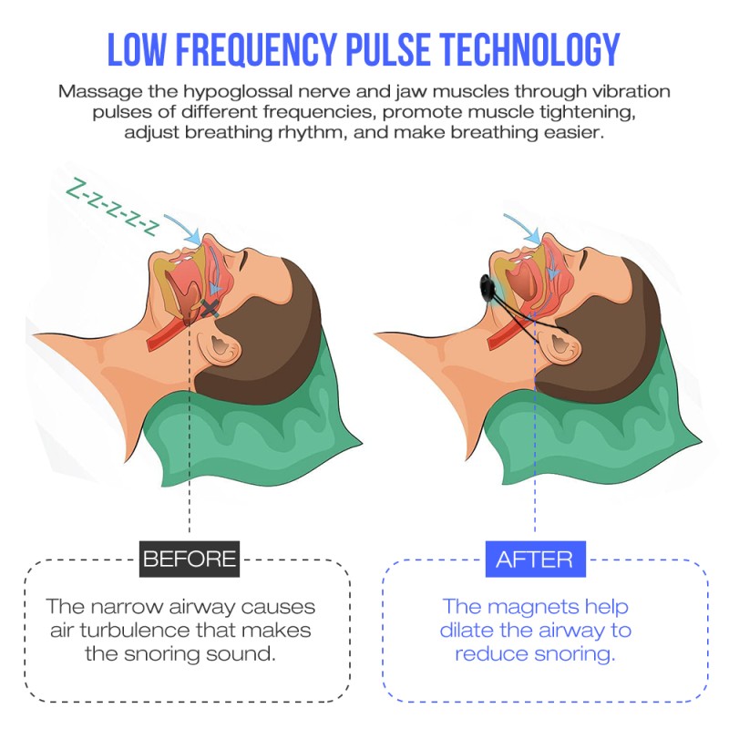 Anti Snoring Device Factory - Top Selling Portable EMS Pulse Stop Snore Sleep Aid Tool
