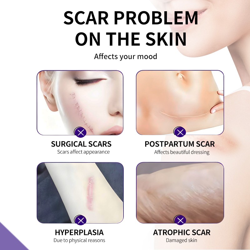 Scar Removal Cream Supplier - Professional Medical Grade Scar Removal Cream Natural Herbal Formula