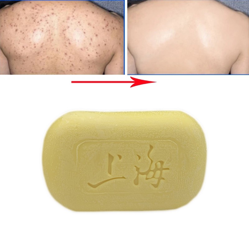 Sulfur Soap Manufacturer - Shanghai Brand Oil Control Acne Remover 85g