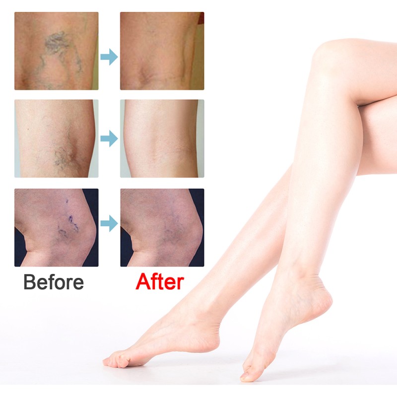 Varicose Vein Cream Factory - 20g Vasculitis Phlebitis Pain Relief