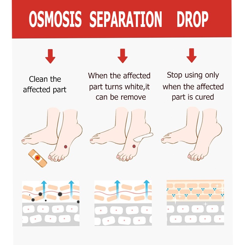 Corn Removal Plaster Manufacturer - OEM Foot Protection Pain
