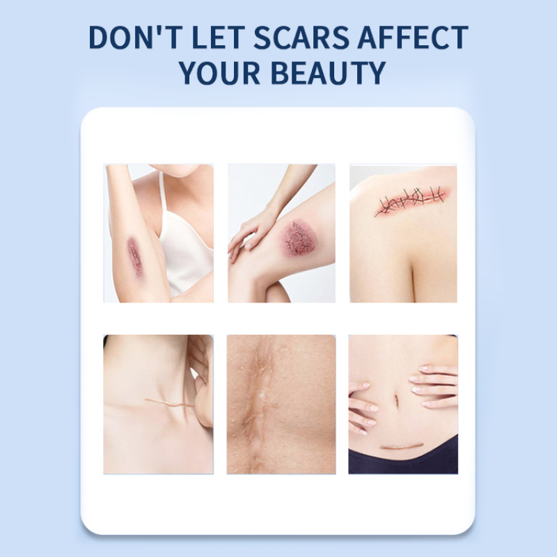 Scars Removal Gel Supplier - OEM High Quality Quick Treatment