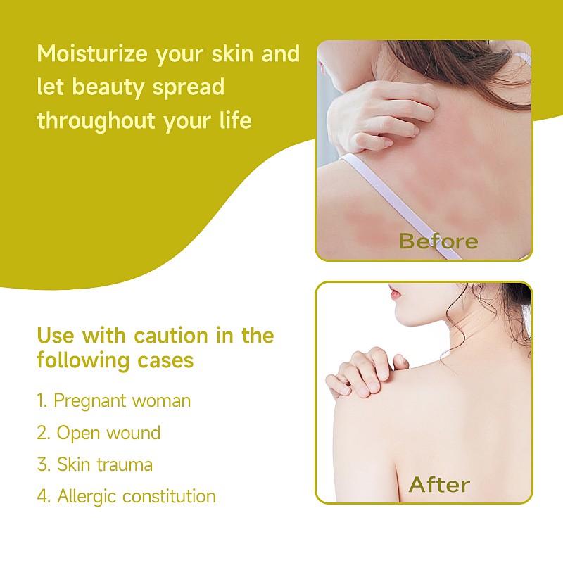 Anti Itch Ointment Manufacturer - Herbal Extract Eczema Sensitive Skin Care