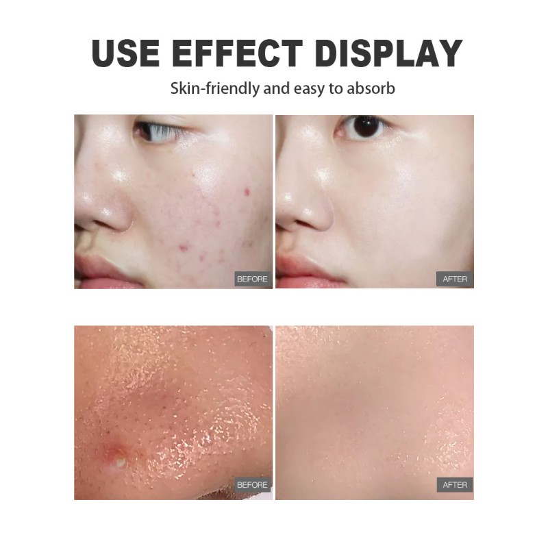 Acne Pads Manufacturer - Alcohol Free Moderate Acne Care
