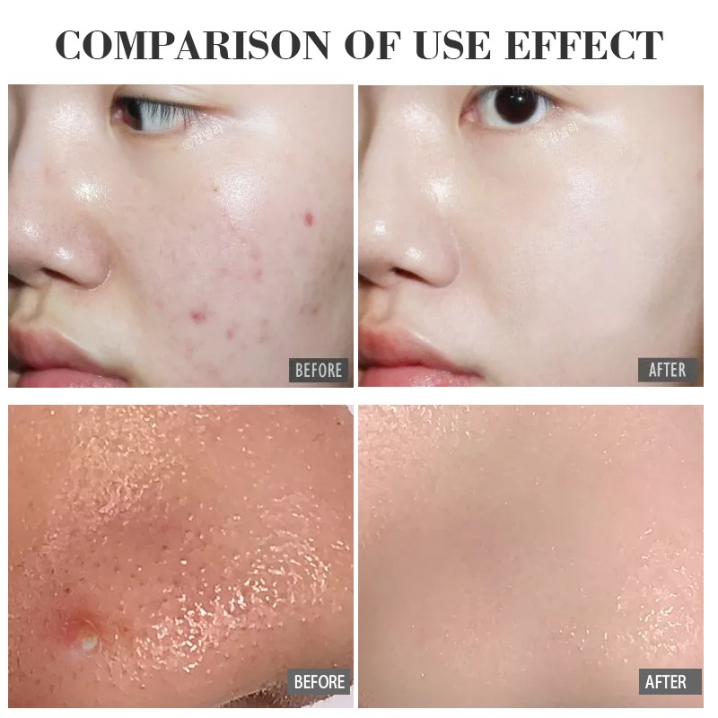 Acne Pads Manufacturer - Alcohol Free Moderate Acne Care