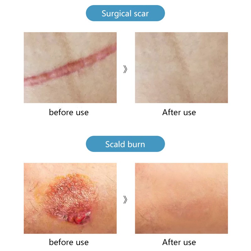 Acne Cream Factory - OEM Adolescent Skin Care Scar Removal