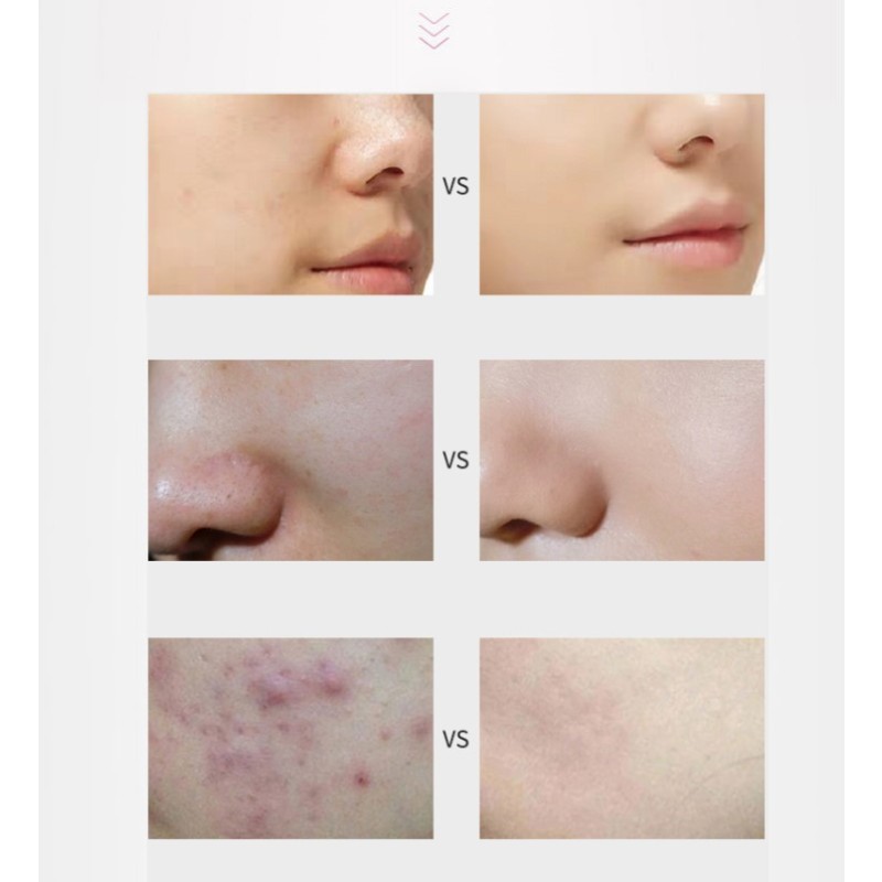 PDRN Mesotherapy Solution - OEM Derma Pen Liquid Manufacturer