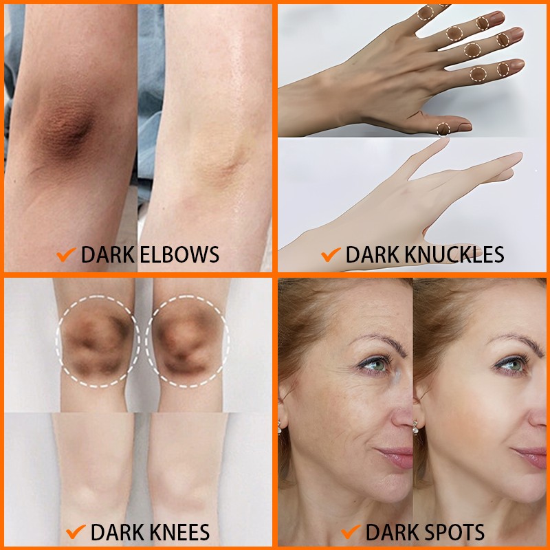 Whitening Skin Care Set - Dark Spot Removal Care