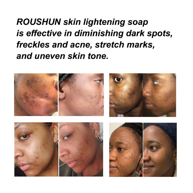 Kojic Acid Soap - Whitening Bar Soap Wholesale