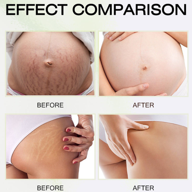 Stretch Mark Cream - Scar Repair Moisturizing