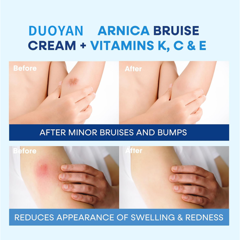 Body Lotion 4oz - Fast Acting Bruise Care