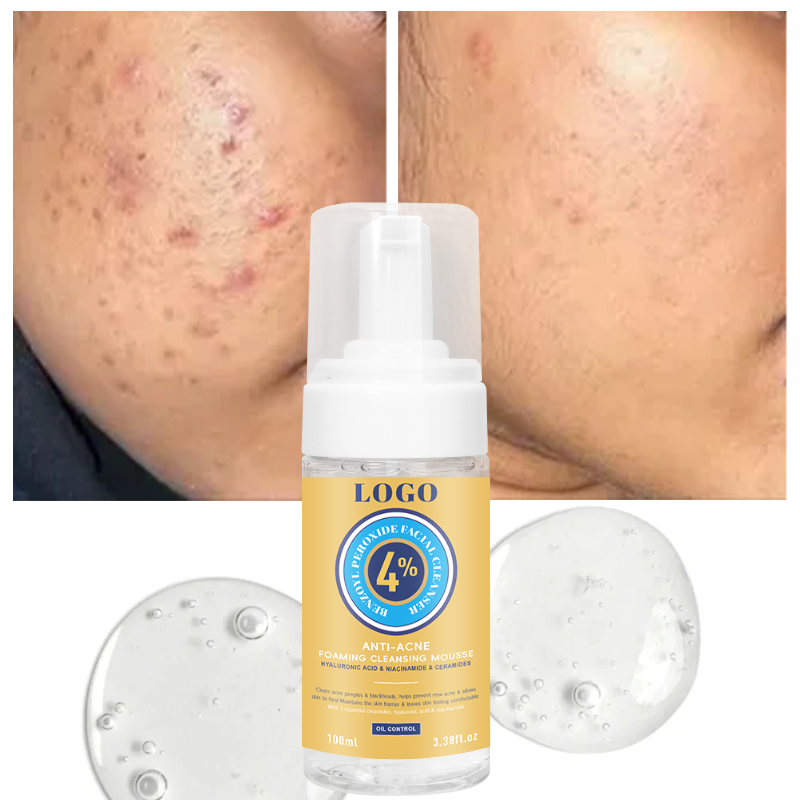 Acne Cleanser - 4% Benzoyl Peroxide Oil Control