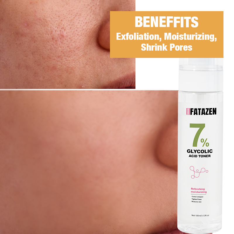 Face Toner - 7% Glycolic Acid Acne Treatment
