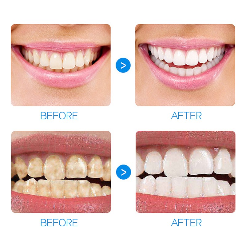 Teeth Whitening Kit - Natural Plaque Removal