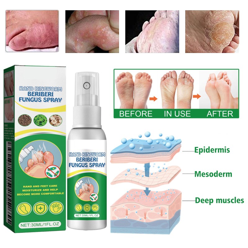 Foot Spray 30ml - Antifungal Herbal Treatment