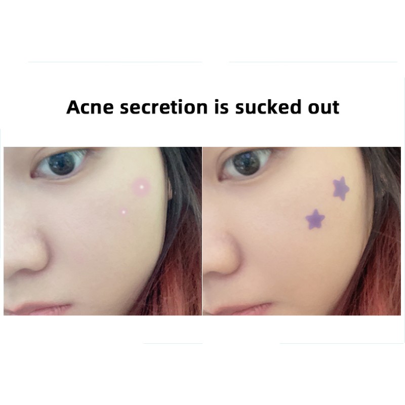 Acne Patch - OEM Hydrocolloid Pimple Treatment Supplier