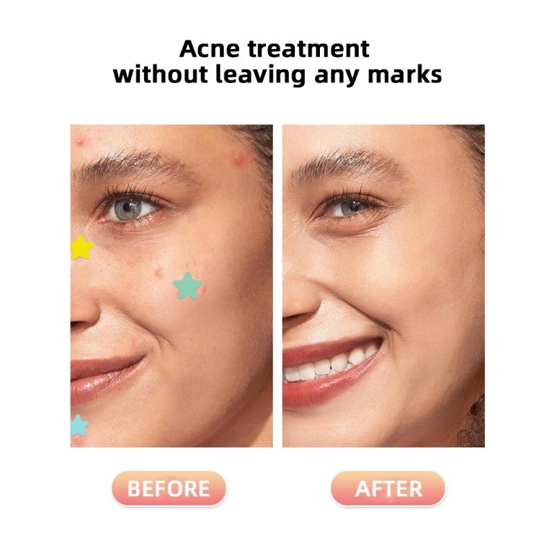 Acne Patch - OEM Hydrocolloid Pimple Treatment Supplier