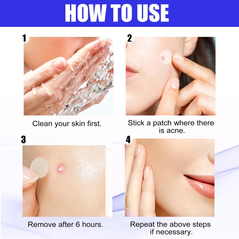 Acne Patch - OEM Hydrocolloid Pimple Treatment Supplier