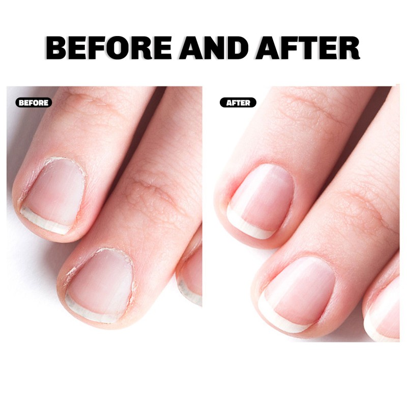 Wart Care Solution 20ml - Bee Venom Keratosis