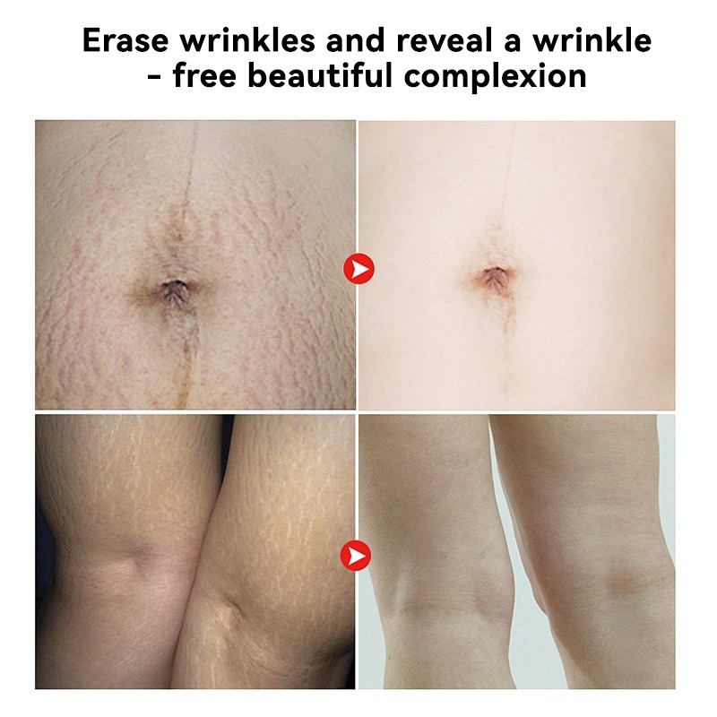 Skincare Essence Oil Manufacturer - MULAN Women Stretch Mark Dry Skin