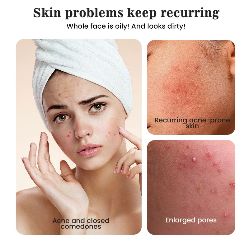 Acne Treatment Toner Manufacturer - MULAN Tea Leaf Niacinamide Salicylic Acid