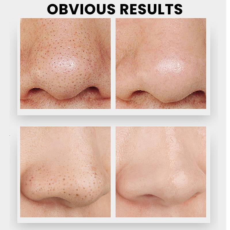 Blackhead Essence Manufacturer - MULAN Private Label Exfoliating Oil