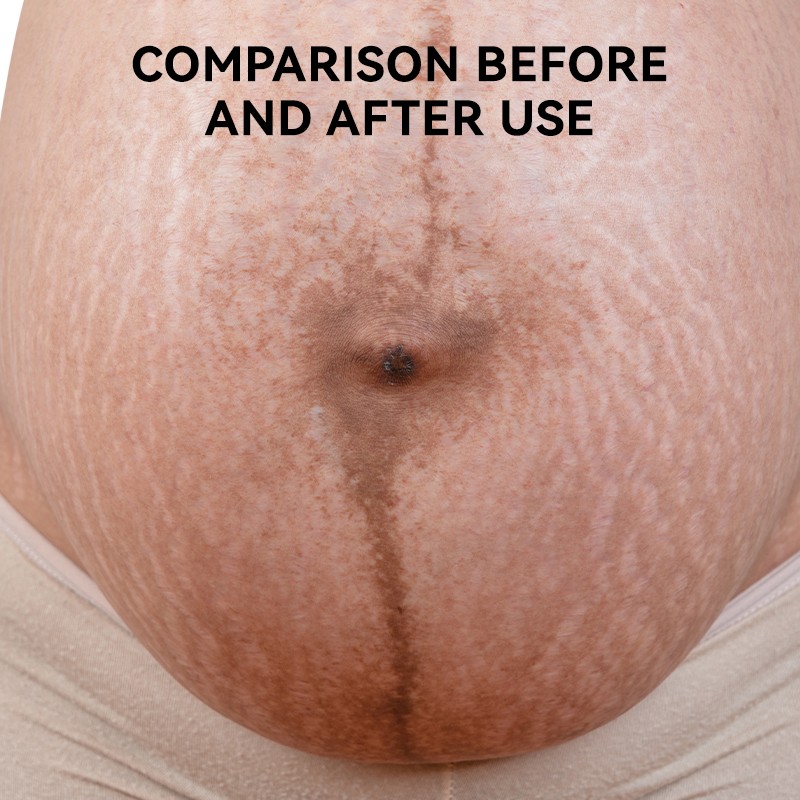 Skincare Essence Oil Manufacturer - MULAN Women Stretch Mark Dry Skin