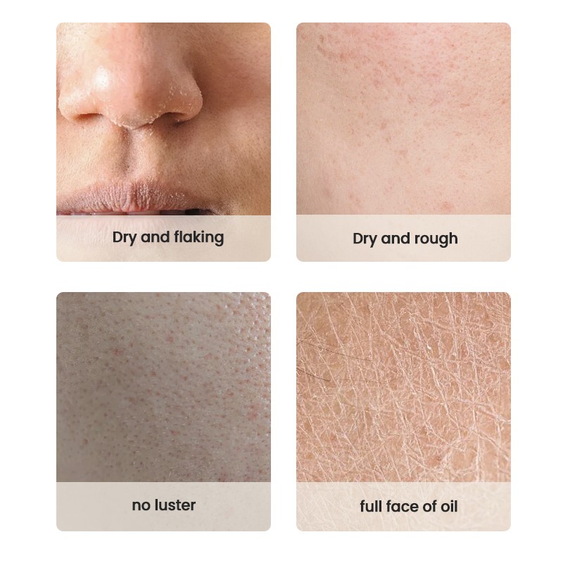 Skin Care Set Factory - MULAN Custom Acne Treatment Korean Style