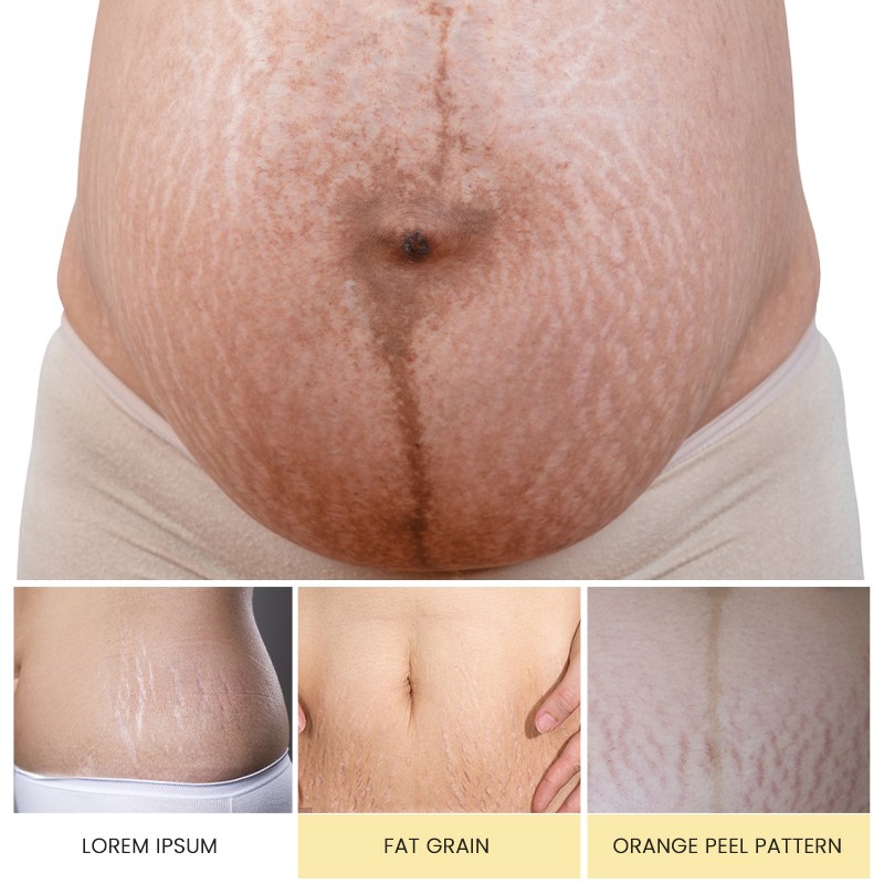 Massage Oil Manufacturer - MULAN Organic 30ml Nourishing Stretch Mark