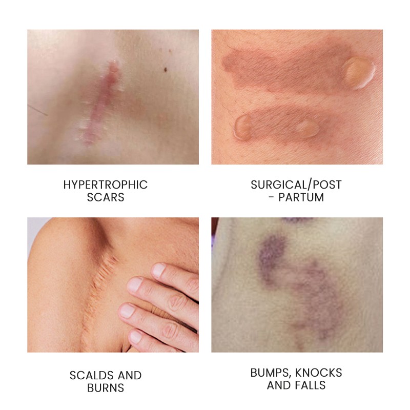 Anti Scar Gel Factory - MULAN Silicone Oil Old Scars Removal Prevention