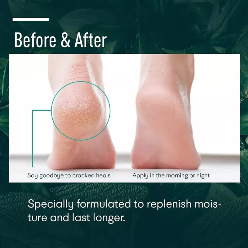 Urea Cream Supplier - Bulk 40% Cracked Heels