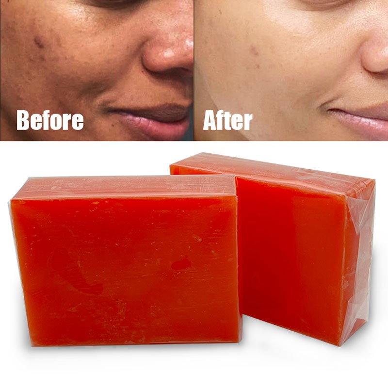 Toilet Soap Supplier - Manufacturing Anti Acne Dark Spots