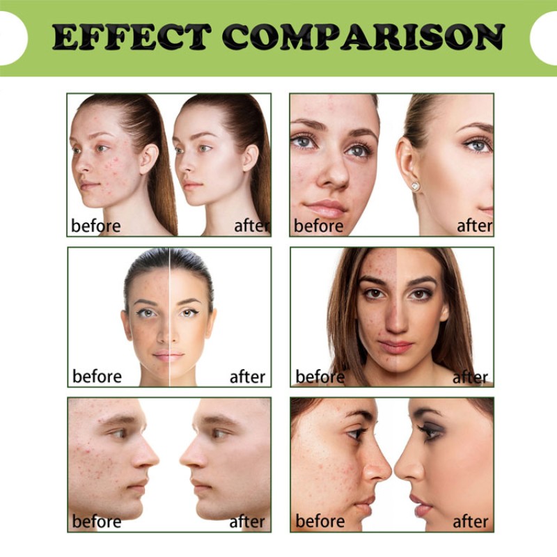 Facial Serum Supplier - 30 ml Herbal Plant Anti Wrinkle Acne Remover Serum