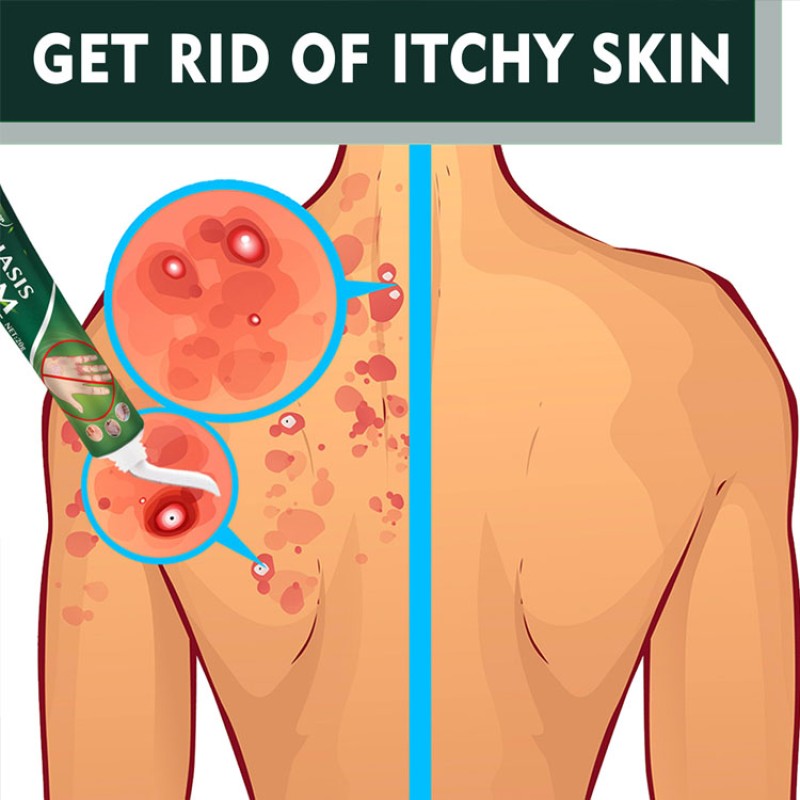 Anti-itch Ointment Manufacturer - South Moon Herbal Extract Psoriasis Cream