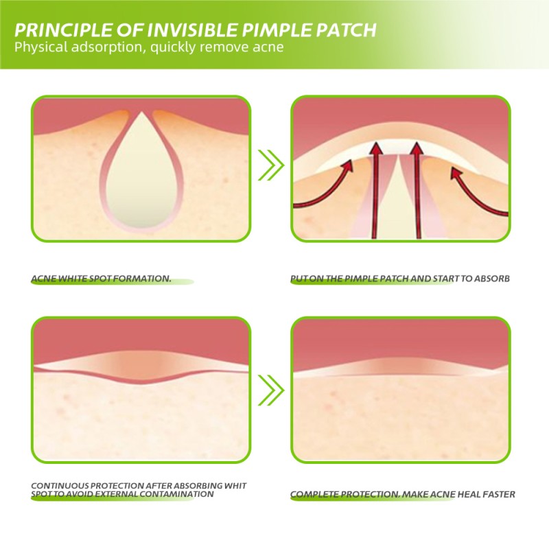 Pore Patches Supplier - Deep Cleaning Healing Blemish Blackhead Hydrocolloid