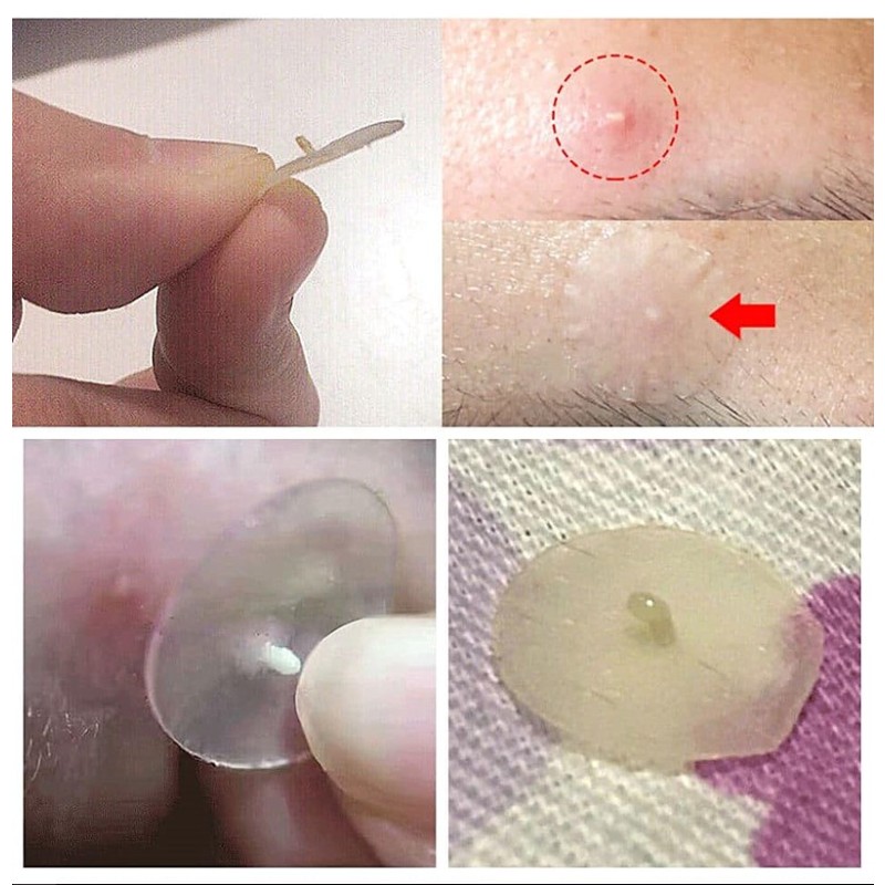 Acne Patches Supplier - Korean Hydrocolloid Pimple Treatment Invisible Private