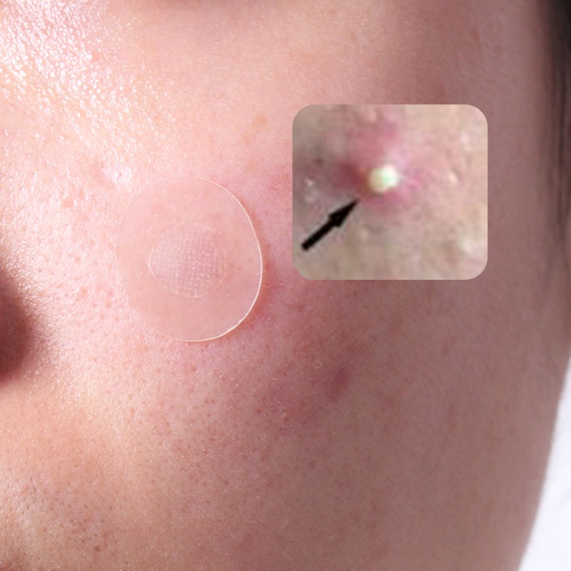 Acne Patch Supplier - Dissolving Waterproof Hydrocolloid Microneedle Hyaluronic